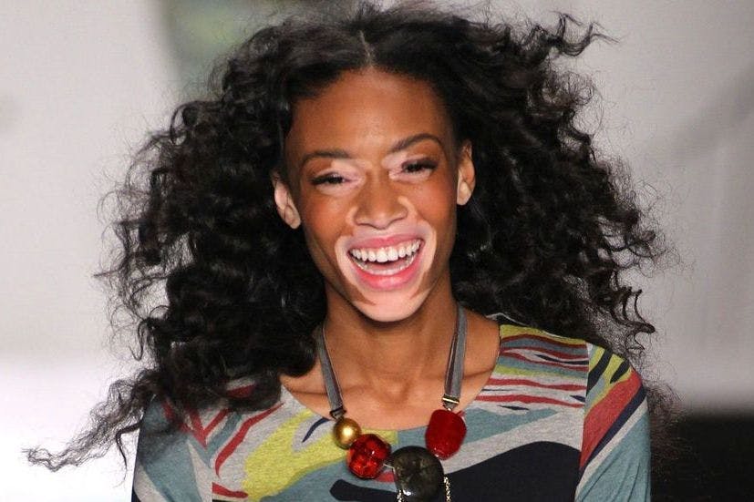 Model With Rare Skin Condition Proves Imperfection Is Beautiful At New